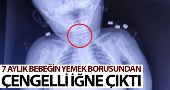 7 aylık bebeğin yemek borusundan çengelli iğne çıktı