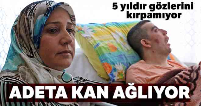 5 yıldır gözlerini kırpamıyor, adeta kan ağlıyor