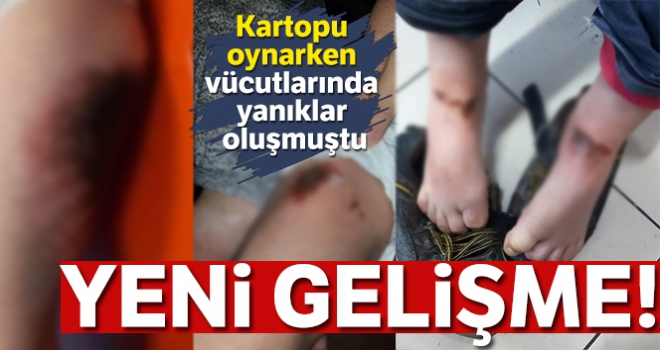 Kartopu oynarken yanan çocuklara doku nakli yapılacak