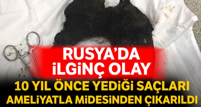 10 yıl boyunca yediği saçları ameliyatla midesinden çıkarıldı